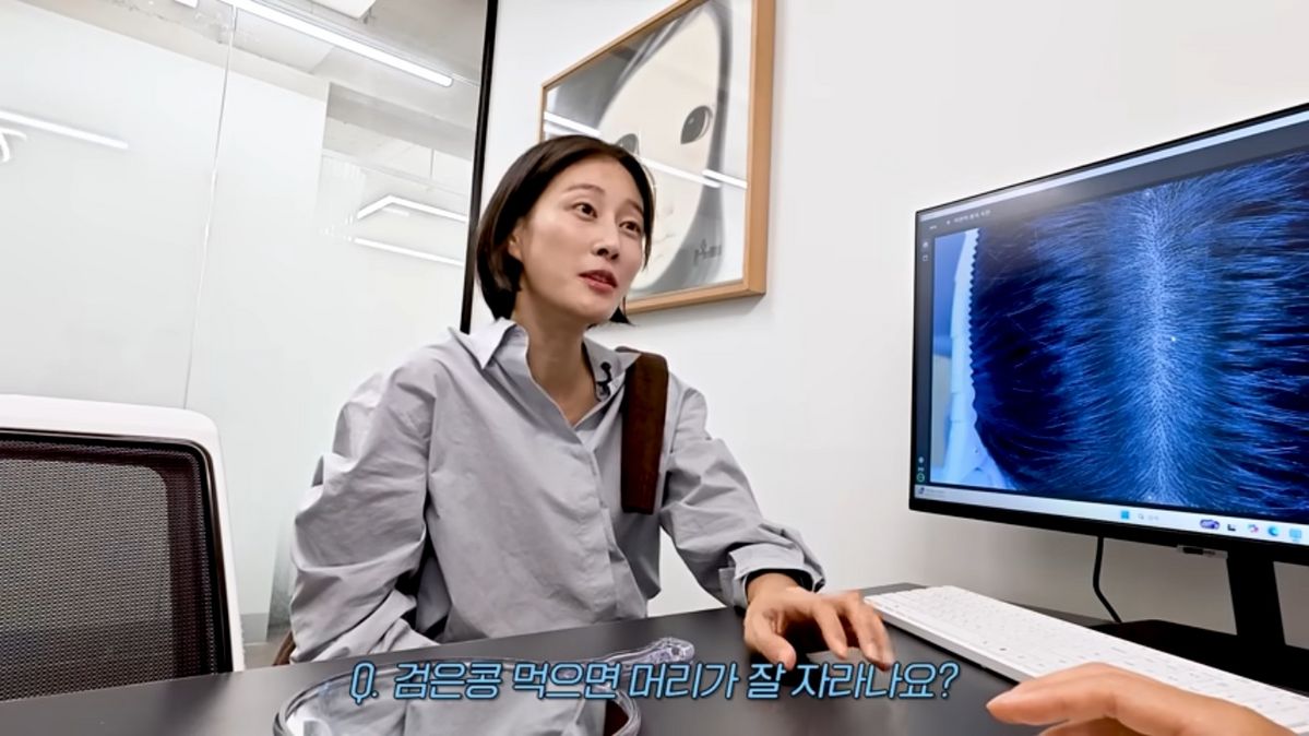 이현이 모발 이식 | 출처 유튜브 <워킹맘 이현이>