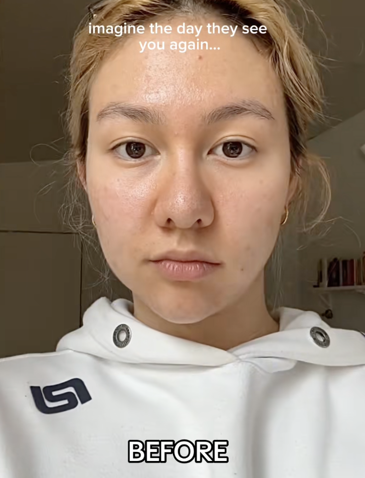 틱톡에서 바이럴 중인 이소티논의 코 미용 효과 ‘accutane nose’. 틱톡 @abigailpalmr