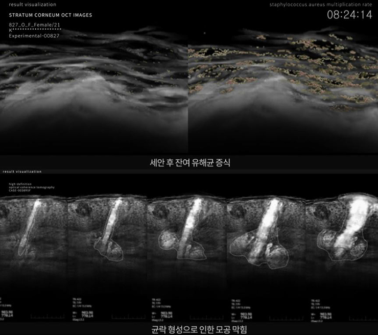 모공에 쌓여 증식한 유해 균은 끈적한 피지와 악성 피부 문제를 발생시킨다. *이해를 돕기 위해 제작한 가상의 연출 사진입니다.